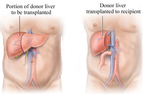 Liver Transplantation in India