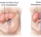 Liver Transplantation in India