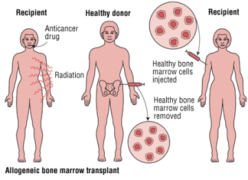 Bone marrow transplant