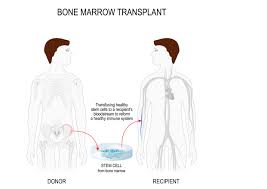 Bone Marrow Transplant Hospitals in India 