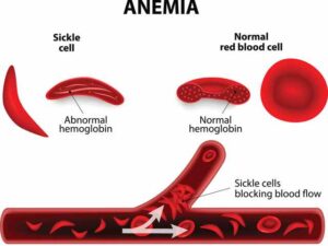 sickle cell dsease treatment in India