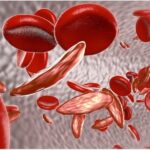 Sickle Cell Anemia Treatment Cost in India