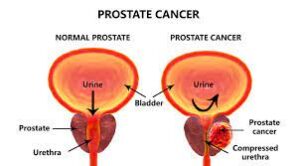 Best Prostate Cancer treatment in India