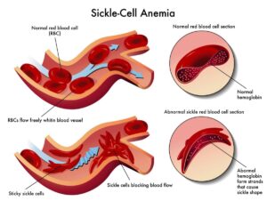 Best Sickle Cell Anemia treatment in India