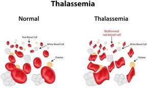 Thalessemia treatment cost in India 