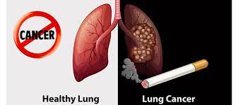 Lung Cancer treatment cost in India 